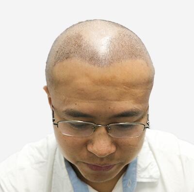 擺脫發(fā)型不好的日子，植發(fā)讓程序員小哥擺脫發(fā)型困擾！