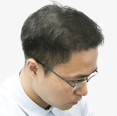 擺脫發(fā)型不好的日子，植發(fā)讓程序員小哥擺脫發(fā)型困擾！