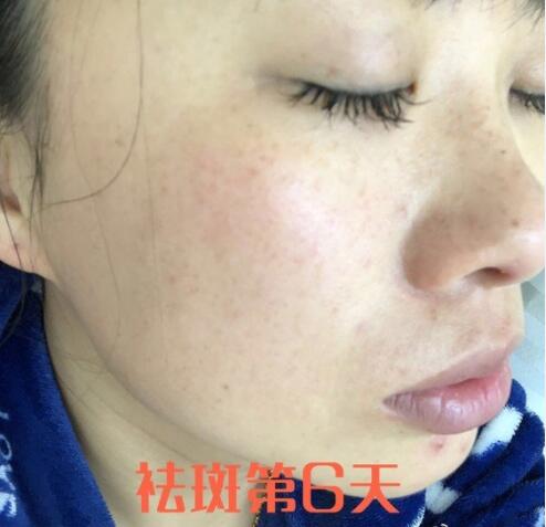 蚌埠祛斑體驗(yàn)日記
