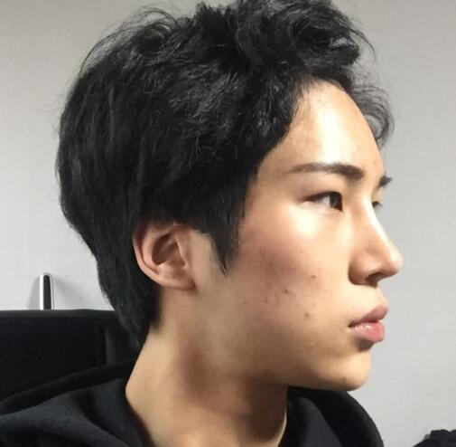 男生顴骨顴弓整形體驗(yàn)日記