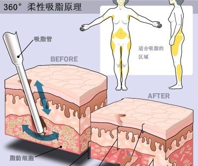 腰腹部吸脂減肥手術(shù)科普