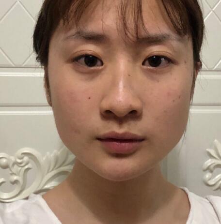 上海九院柴崗磨骨手術(shù)案例分享