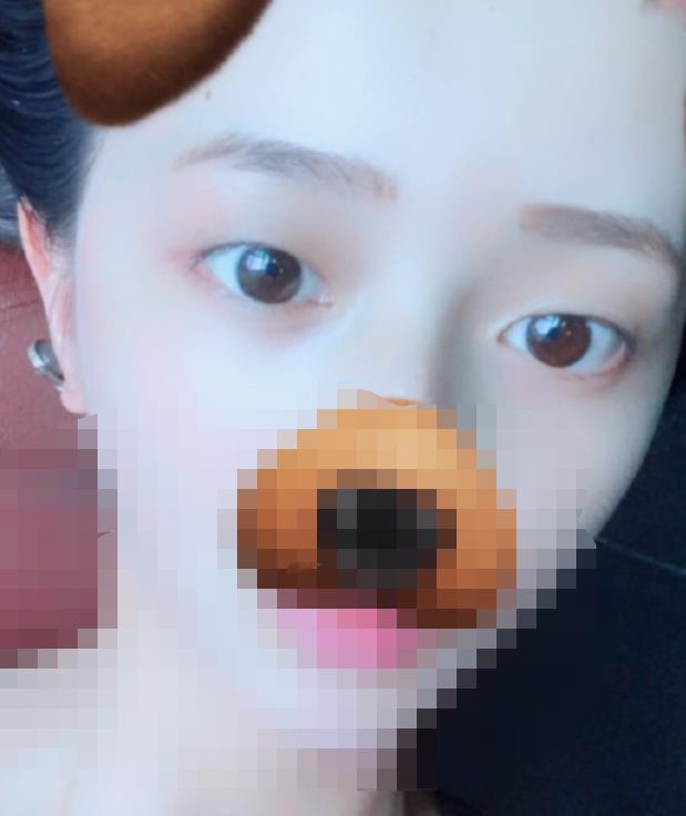 北京八大處趙延勇醫(yī)生做雙眼皮怎么樣？