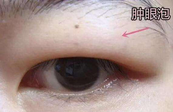 什么是眼皮抽脂術(shù)