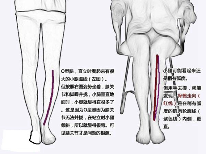 O型腿矯正