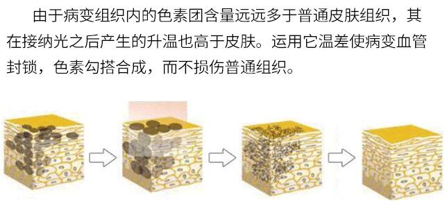 激光洗眼線簡介