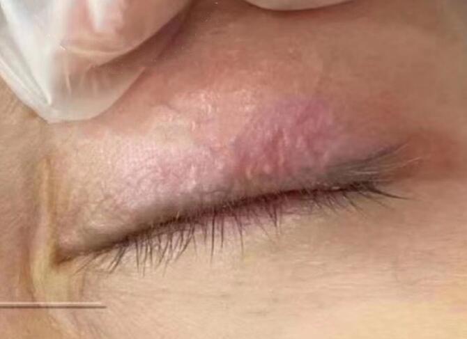 激光洗眼線多久能恢復(fù)