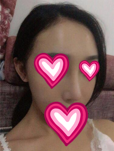 深圳保麗圣瑞醫(yī)療美容隆鼻案例分享