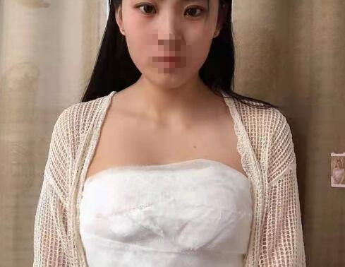 廣州艾菲莎醫(yī)療美容脂肪豐胸案例分享