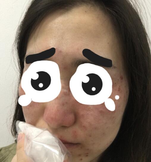 廣州美博匯整形激光祛斑案例分享