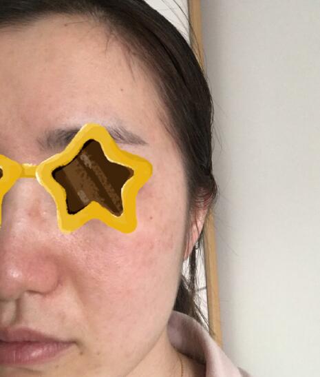 廣州美博匯整形激光祛斑案例分享
