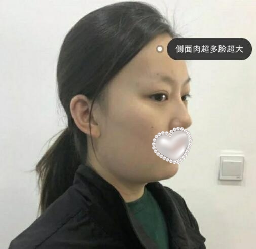 深圳四季醫(yī)療美容案例吸脂分享