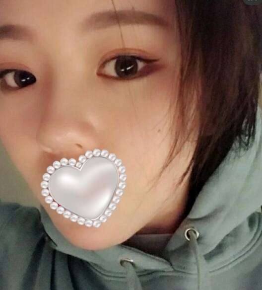 深圳四季醫(yī)療美容案例吸脂分享