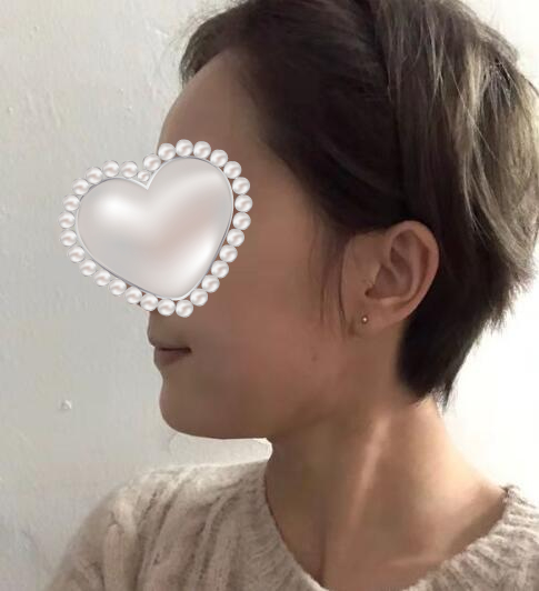 深圳江南春天整形醫(yī)院面部吸脂案例分享