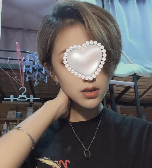 深圳江南春天整形醫(yī)院面部吸脂案例分享