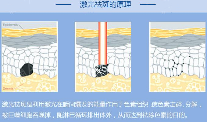 藍寶石激光祛斑原理簡介