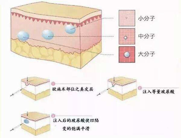 透明質(zhì)酸注射除皺