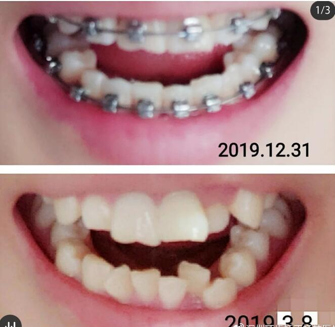 北京佳美口腔牙齒矯正案例分享