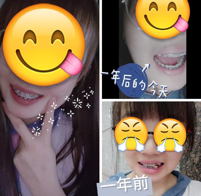 北京佳美口腔牙齒矯正案例分享