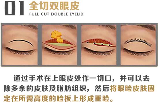 八大?處宋濤醫(yī)生雙眼皮知識科普 