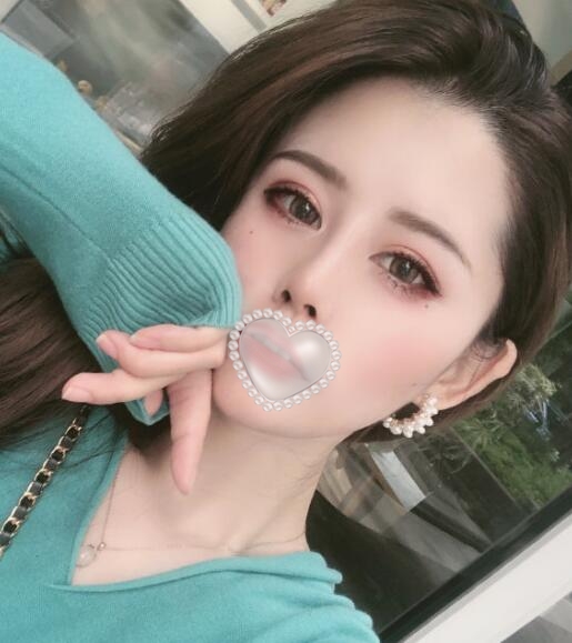 svf脂肪膠填充體驗案例果