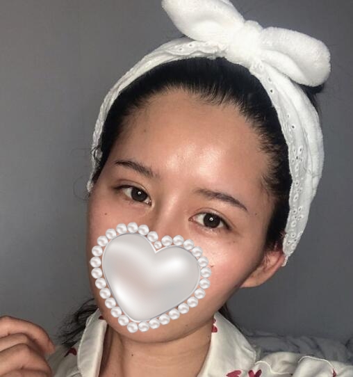 svf脂肪膠填充體驗案例果