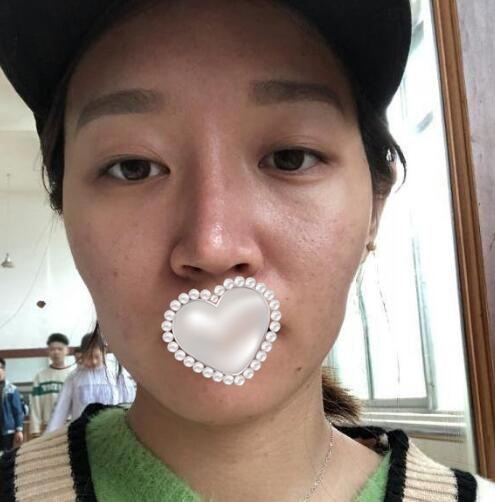 衡陽(yáng)雅美姚江華醫(yī)生脂肪填充?案例