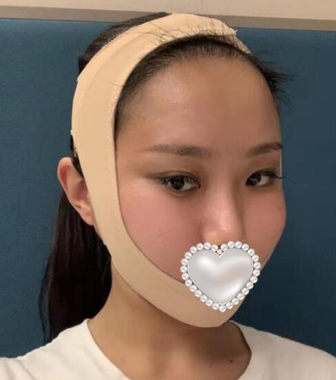 北京八大處整容醫(yī)院磨骨案例