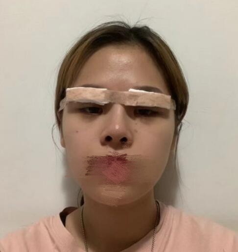 北京劉風(fēng)卓做雙眼皮修復(fù)案例