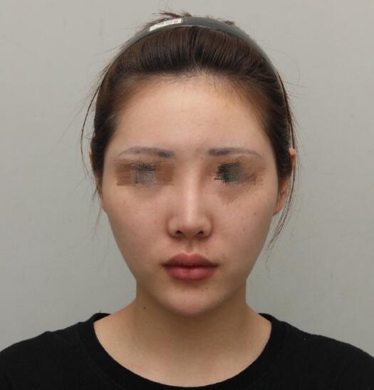 做歪鼻矯正果圖分享