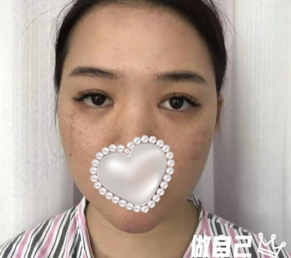 東莞壹加壹整形美容隆鼻案例