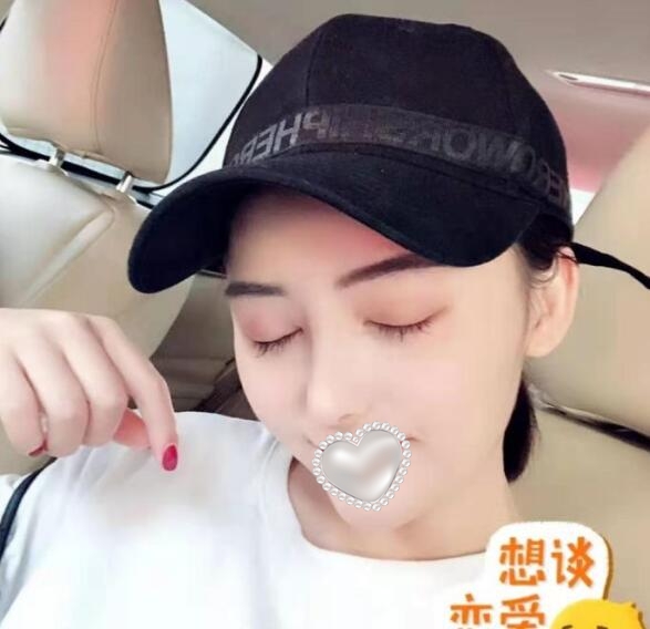 東莞壹加壹整形美容隆鼻案例