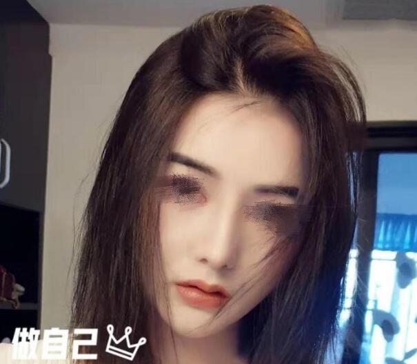 東莞壹加壹整形美容隆鼻案例