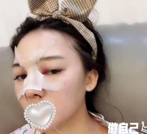 東莞壹加壹整形美容隆鼻案例