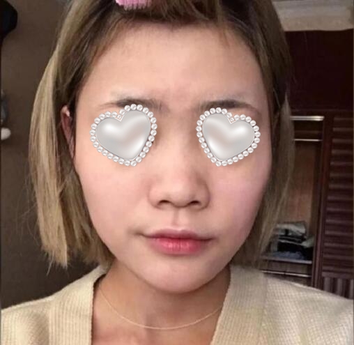 無(wú)錫同濟(jì)整形美容隆鼻案例