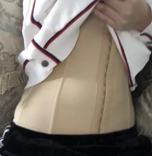 上海歐萊美整形醫(yī)院吸脂案例分享