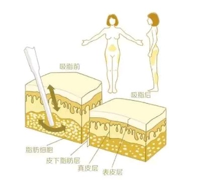 上海歐萊美整形醫(yī)院科普吸脂手術注意事項