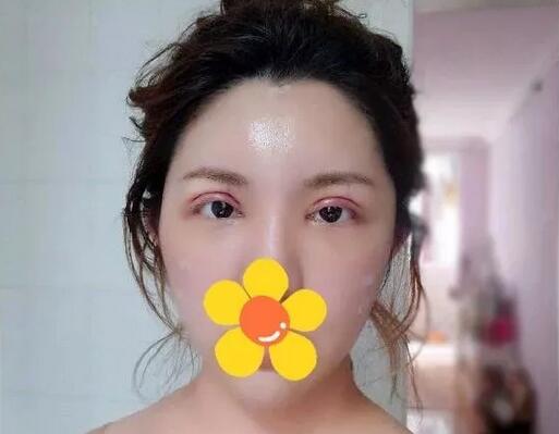 上海珂萊婭整形醫(yī)院雙眼皮案例分享