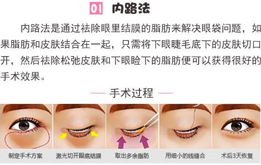 八大處美容醫(yī)院科普去眼袋手術