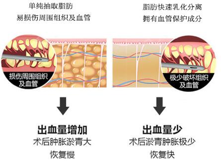 四、八大處美容整形科普腰腹吸脂手術(shù)
