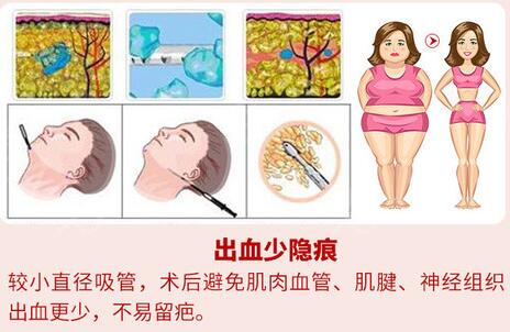 八大處美容整形科普腰腹吸脂手術(shù)