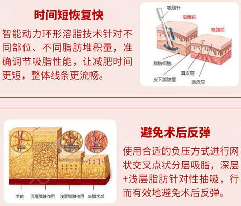 八大處美容整形科普腰腹吸脂手術(shù)