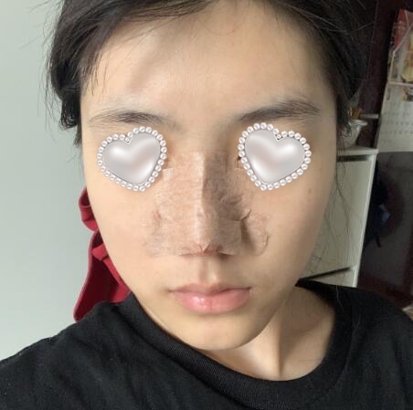 武漢伽美醫(yī)療美容隆鼻案例分享