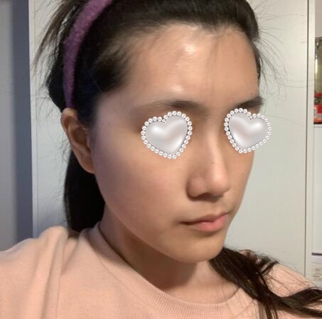 武漢伽美醫(yī)療美容隆鼻案例分享