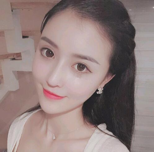 杭州新友好整形隆鼻案例分享