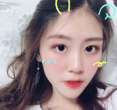 武漢華美整形雙眼皮案例