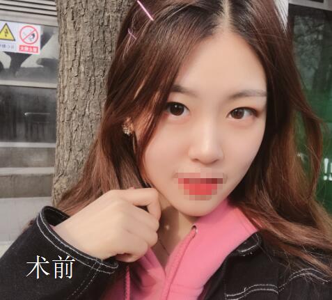 武漢華美整形雙眼皮案例
