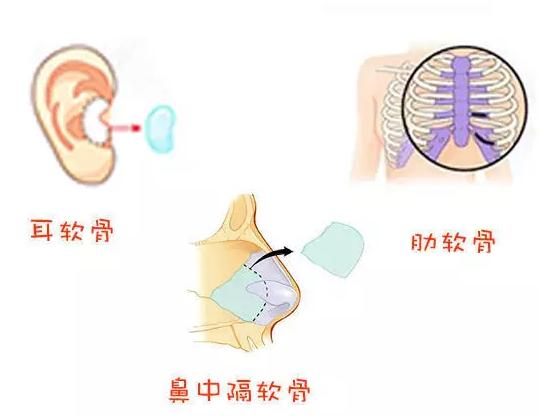 中山一院整形科科普什么是自體軟骨隆鼻
