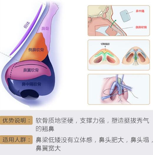 中山一院整形科科普什么是自體軟骨隆鼻