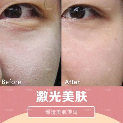 廣州粵美整形醫(yī)院科普激光美白